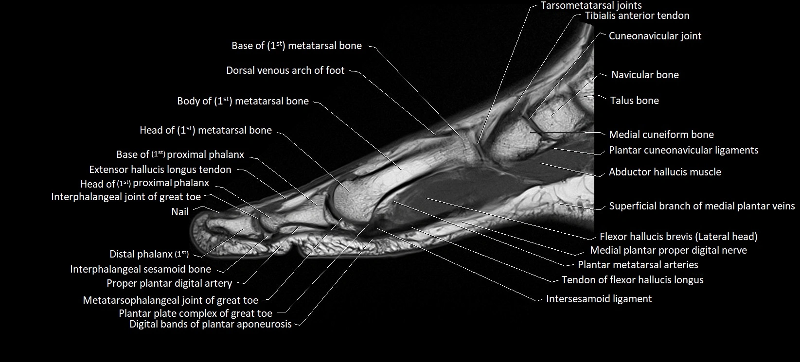 MRI foot sagittal labelled cross sectional anatomy image  6.webp